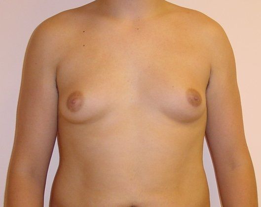 Male Breast Reduction Before And After Photo