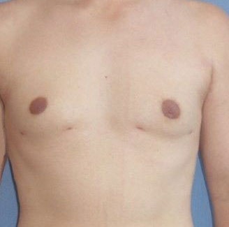 Male Breast Reduction Before And After Patient 2