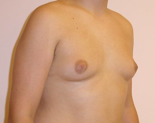 Male Breast Reduction Before And After Photo