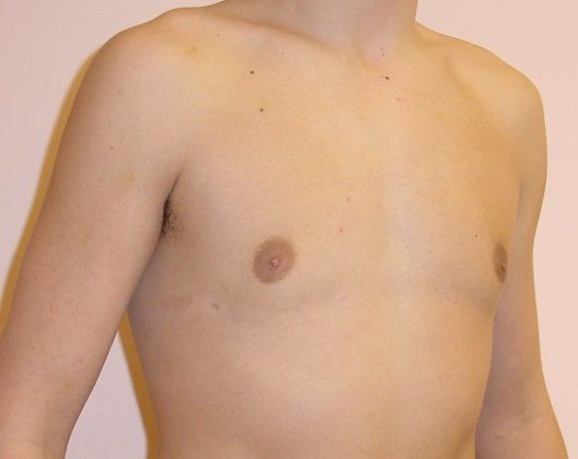 Male Breast Reduction Before And After Photo