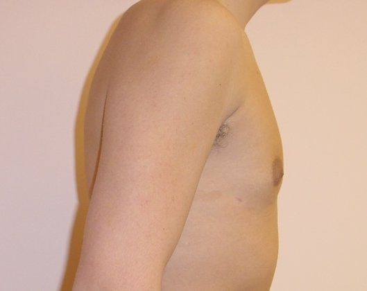 Male Breast Reduction Before & After Image