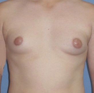 Male Breast Reduction Before And After Photo