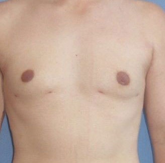 Male Breast Reduction Before And After Photo