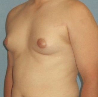 Male Breast Reduction Before And After Photo