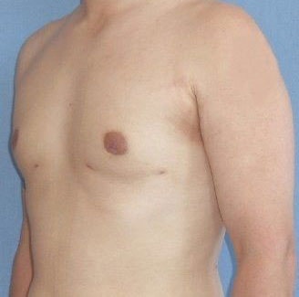 Male Breast Reduction Before And After Photo