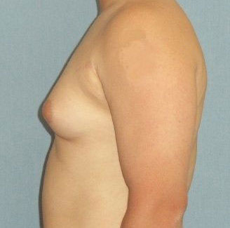 Male Breast Reduction Before And After Photo