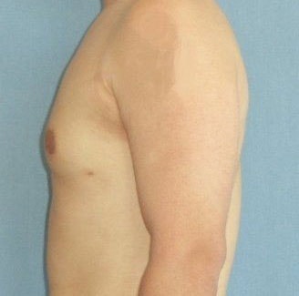 Male Breast Reduction Before And After Photo