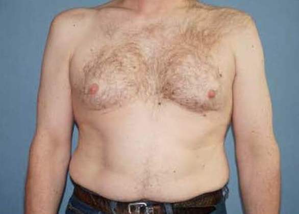 Male Breast Reduction Before And After Photo