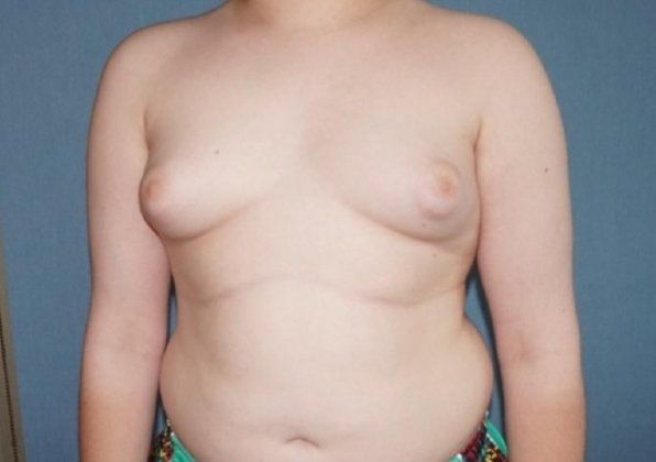 Male Breast Reduction Before And After Photo