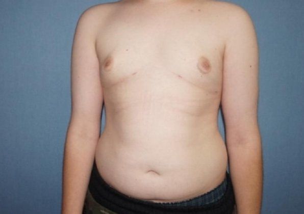 Male Breast Reduction Before And After Photo