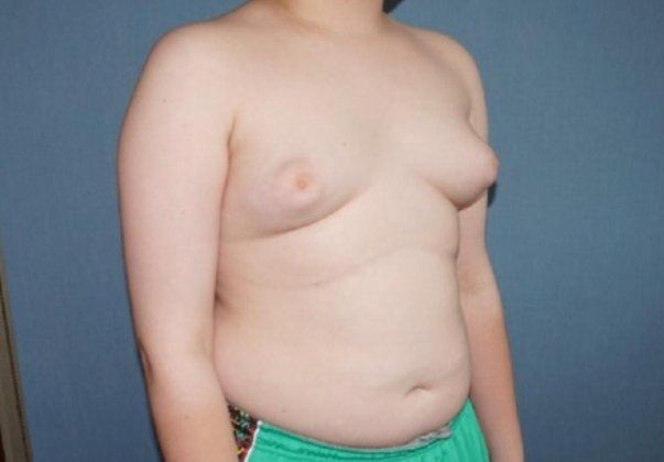 Male Breast Reduction Before And After Photo