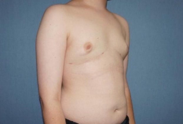 Male Breast Reduction Before & After Image