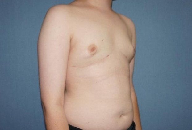 Male Breast Reduction Before And After Photo