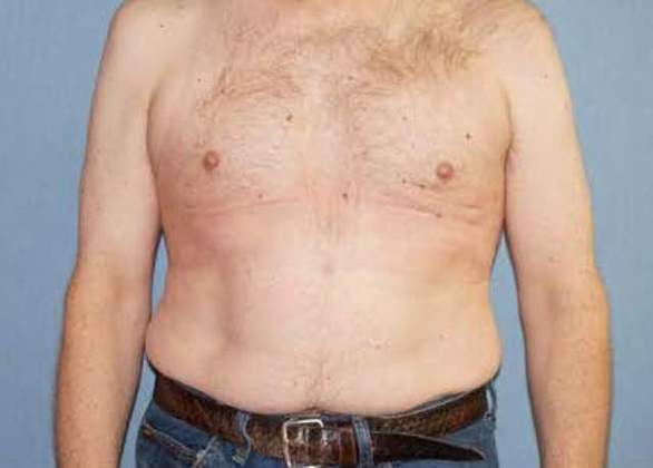 Male Breast Reduction Before And After Photo