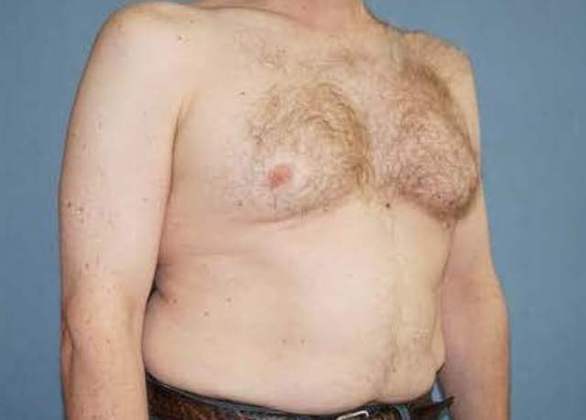 Male Breast Reduction Before And After Photo