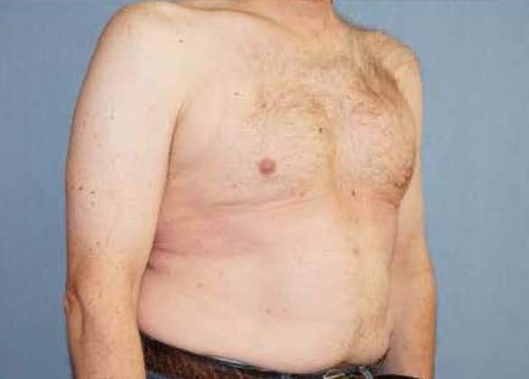 Male Breast Reduction Before And After Photo