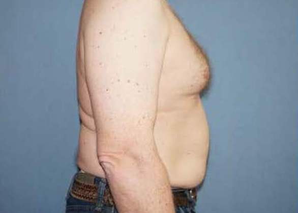 Male Breast Reduction Before And After Photo