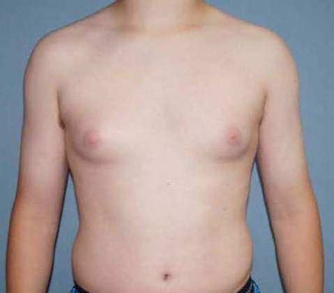 Male Breast Reduction Before And After Photo