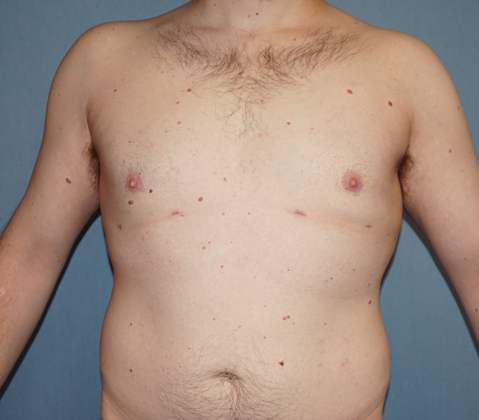 Male Breast Reduction Before And After Patient 6