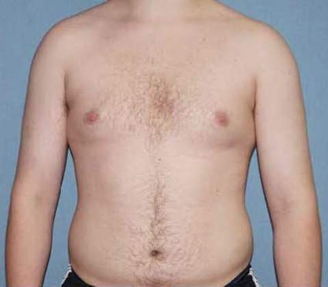 Male Breast Reduction Before And After Patient 6