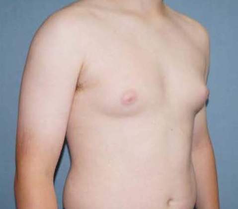 Male Breast Reduction Before And After Photo