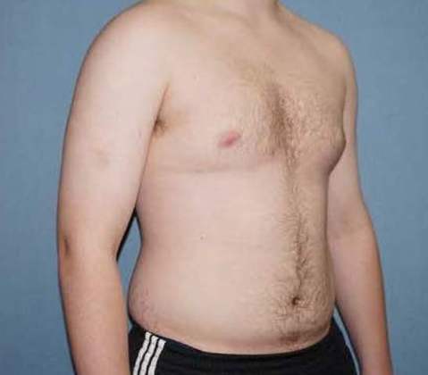 Male Breast Reduction Before And After Photo