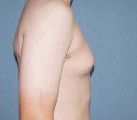 Male Breast Reduction Before And After Photo