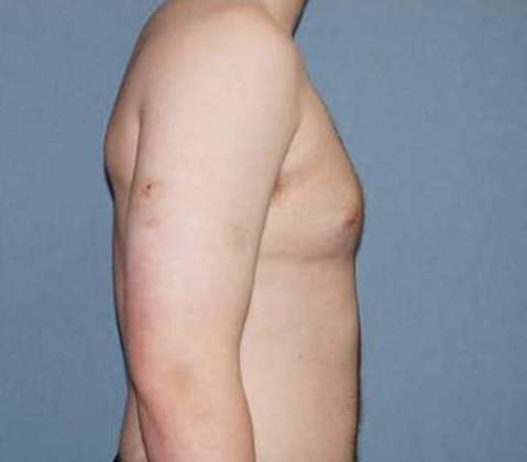 Male Breast Reduction Before And After Photo