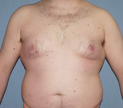 Male Breast Reduction Before And After Photo