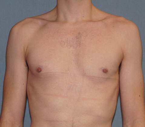 Male Breast Reduction Before And After Patient 7