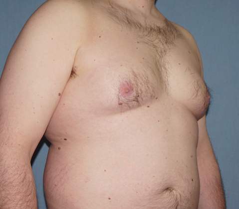 Male Breast Reduction Before And After Photo