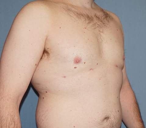 Male Breast Reduction Before And After Photo