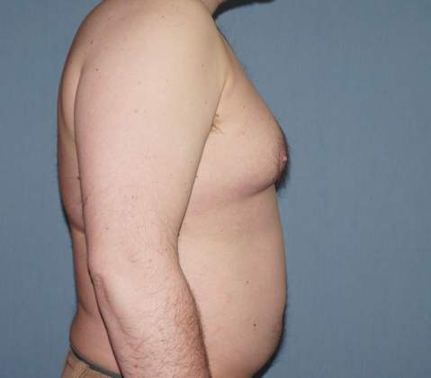 Male Breast Reduction Before And After Photo