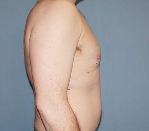 Male Breast Reduction Before And After Photo