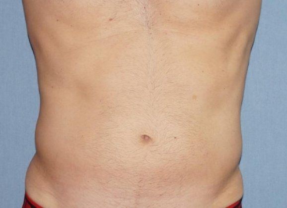 Skin Tightening For Men Before And After Photo