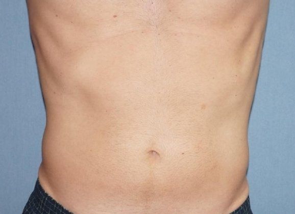 Skin Tightening for Men Before And After Patient 1