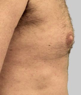 Skin Tightening For Men Before And After Photo