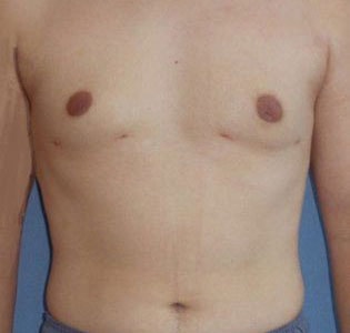 SmartLipo For Men Before And After Photo