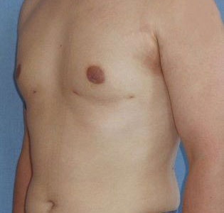 Smartlipo for Men Before & After Image