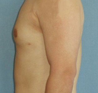 SmartLipo For Men Before And After Photo