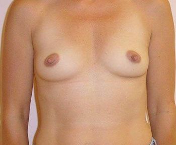 Breast Augmentation NH