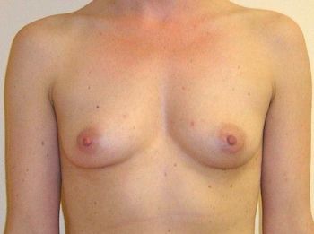 Breast Augmentation Before And After