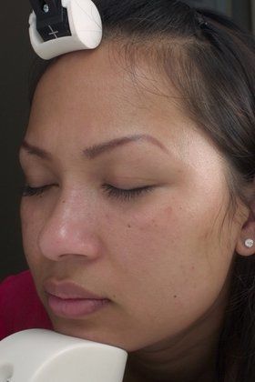 Chelsmford Chemical Peel for Pigmented Scarring Before And After