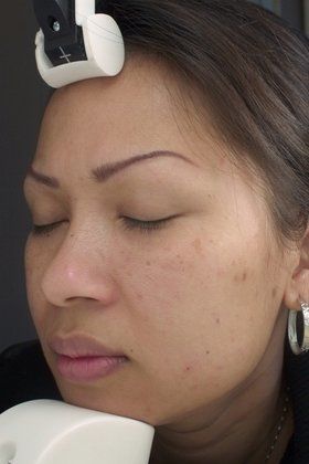 Chemical Peel Chelmsford for Pigmented Scarring Before And After