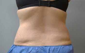 Chelmsford Coolsculpting Before And After Photo