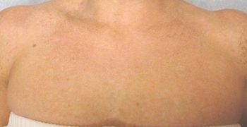 IPL Photofacial Boston Before And After
