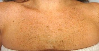 IPL Photofacial Chelsmford Before And After