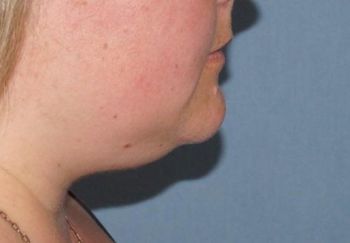 Chelmsford Smartlipo Double Chin Before And After