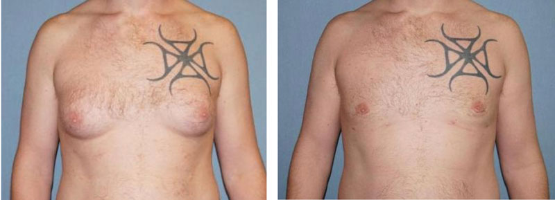 Male Breast Reduction Before and After Photo