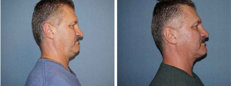 Kybella Double Chin Treatment Before and After Photo